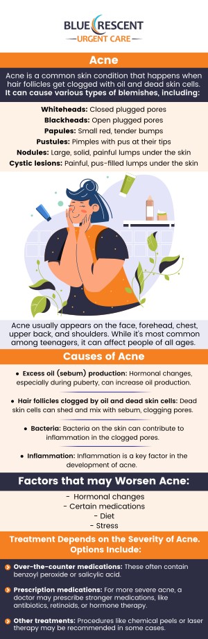 Get trusted and specialized acne treatment at Blue Crescent Urgent Care. For more information, contact us today or book an appointment online. We are conveniently located at 3809 42nd Ave S Suite 100, Minneapolis, MN 55406. We serve patients from Minneapolis MN, Mendota MN, Edina MN, Lauderdale MN, Golden Valley MN, St Paul MN, and BEYOND! Get trusted and specialized acne treatment at Blue Crescent Urgent Care. For more information, contact us today or book an appointment online. We are conveniently located at 3809 42nd Ave S Suite 100, Minneapolis, MN 55406. We serve patients from Minneapolis MN, Mendota MN, Edina MN, Lauderdale MN, Golden Valley MN, St Paul MN, and BEYOND!